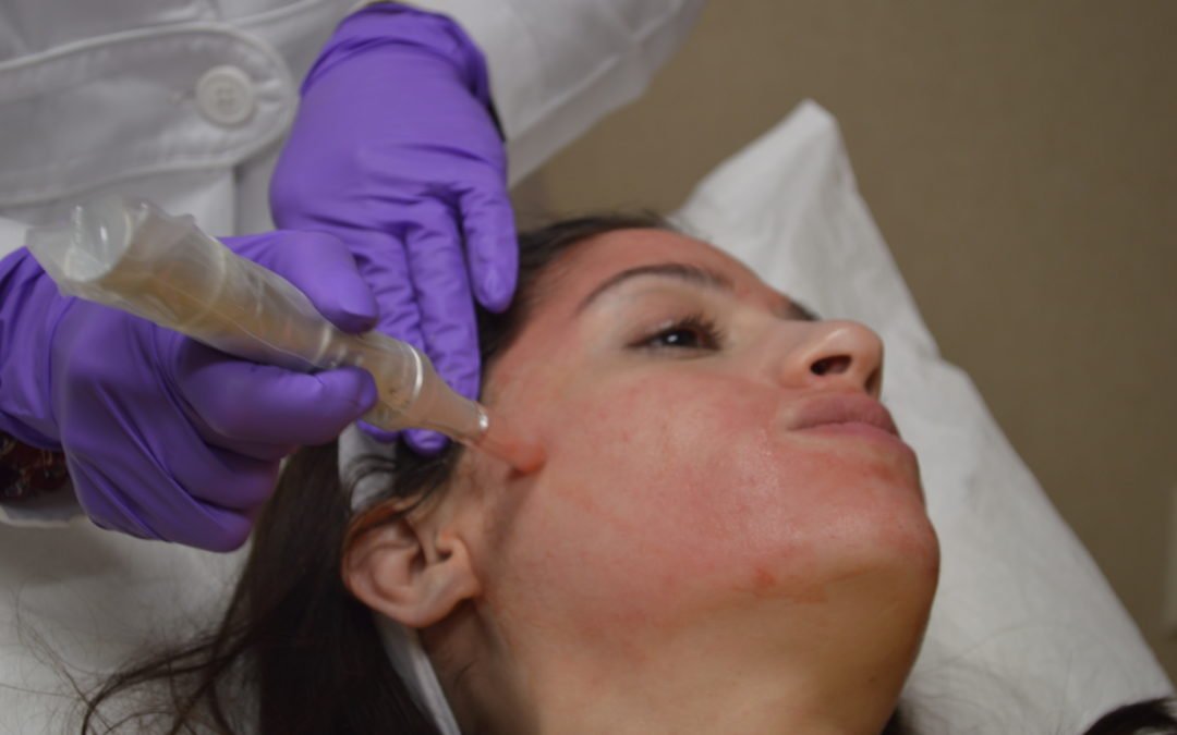 What is the “Vampire Facial”