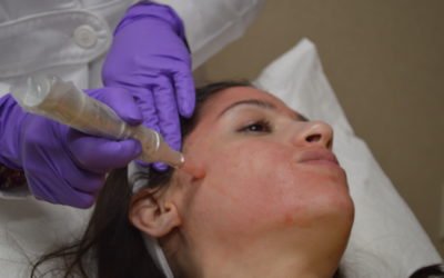 What is the “Vampire Facial”