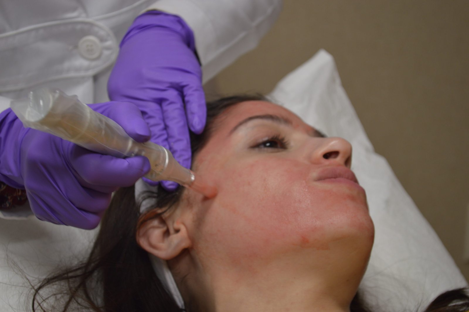vampirefacial
